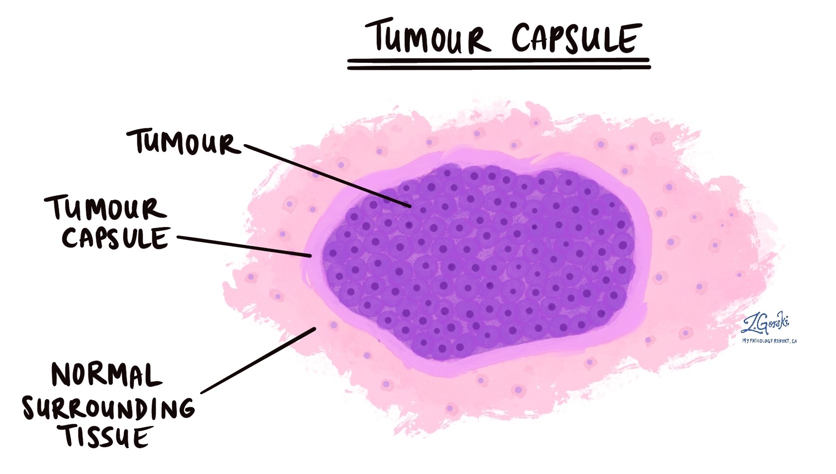 tumour capsule