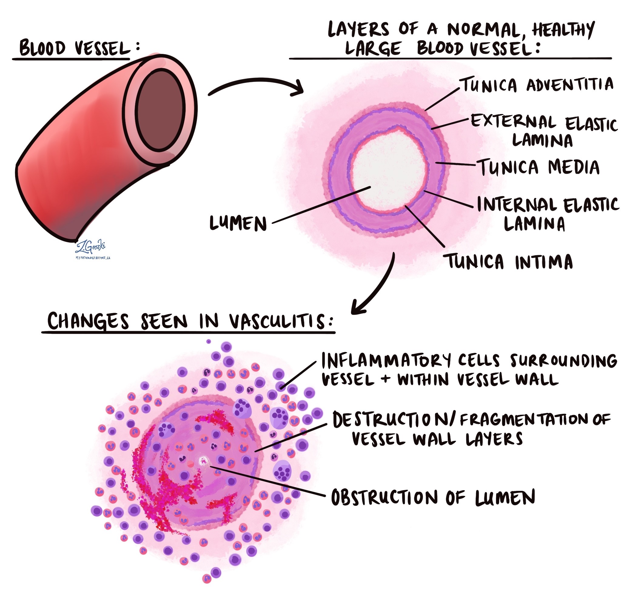 vascularite