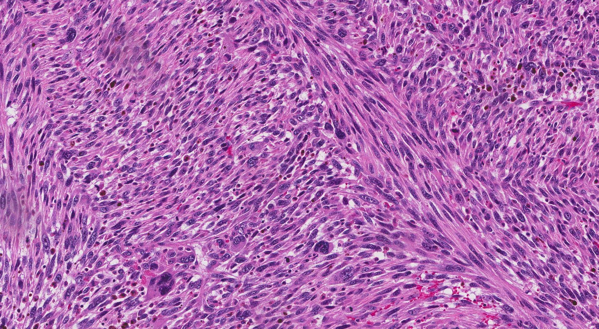 Leiomyosarcoma of the uterus. This picture shows a tumour made up of abnormal looking spindle cells arranged in fascicles.