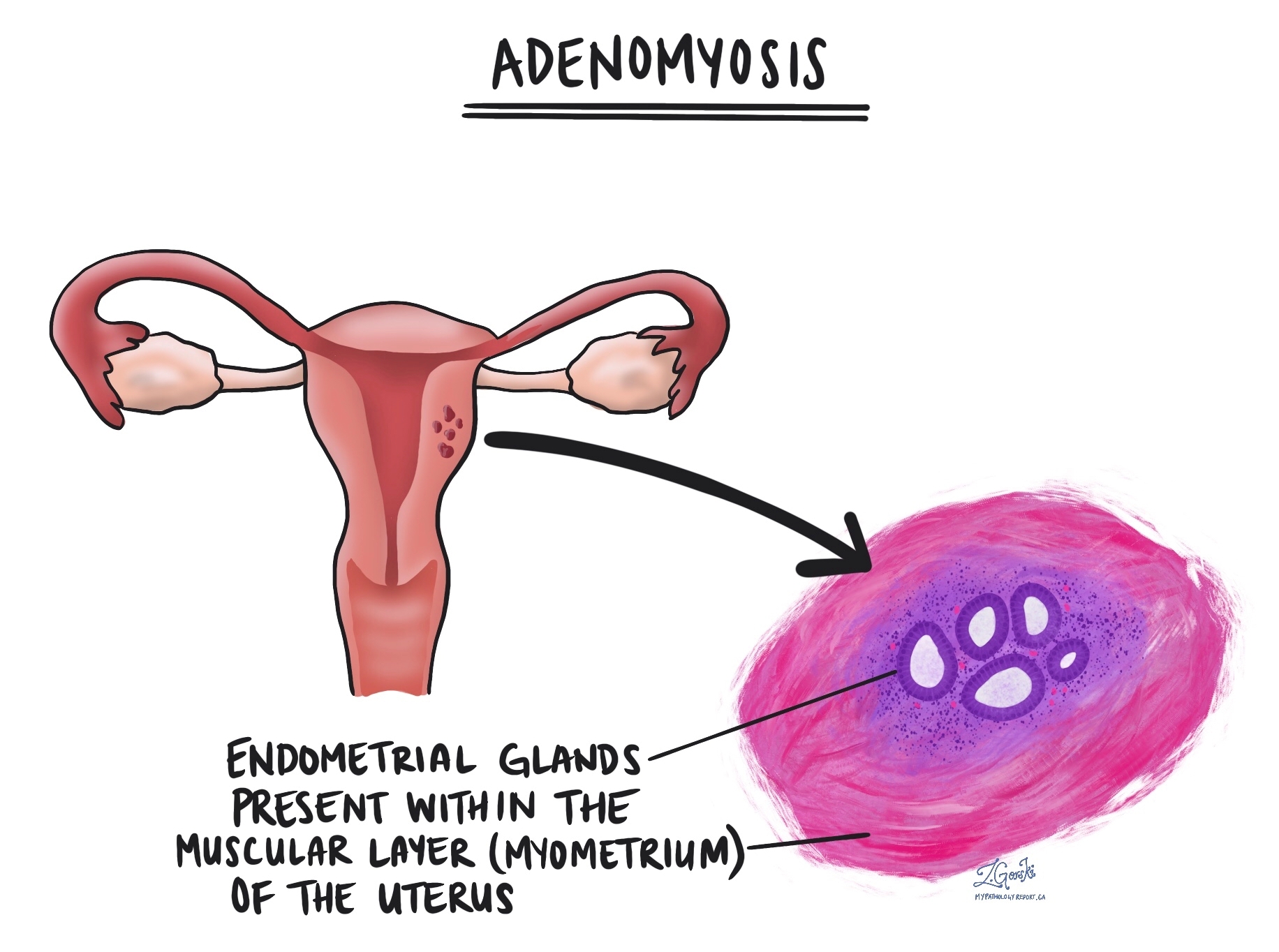 Adenomyosis Adenomyosis vs.