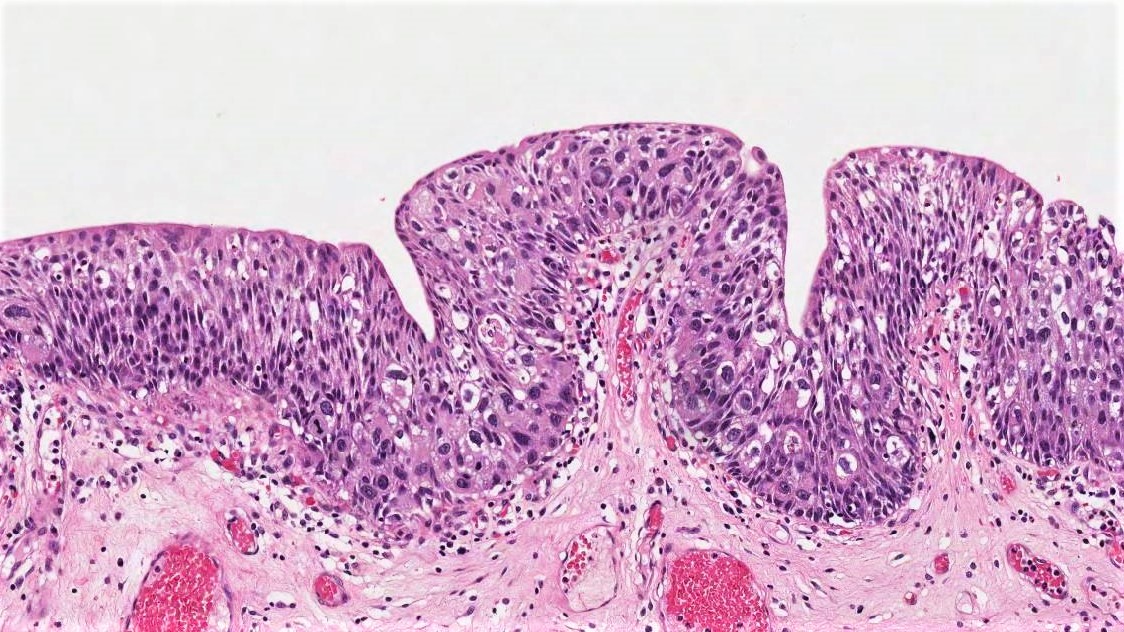 urothelial carcinoma in situ