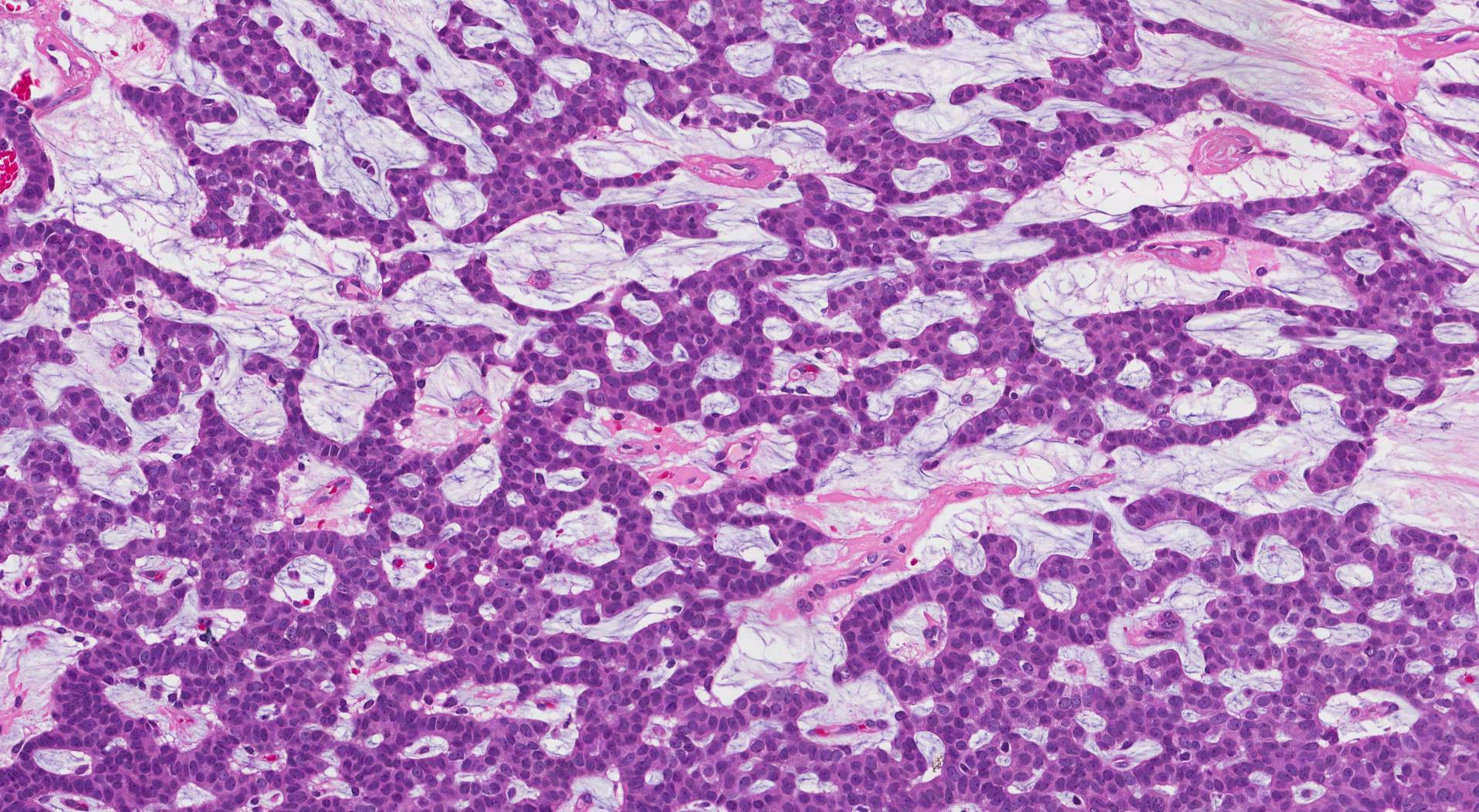 breast invasive mucinous carcinoma