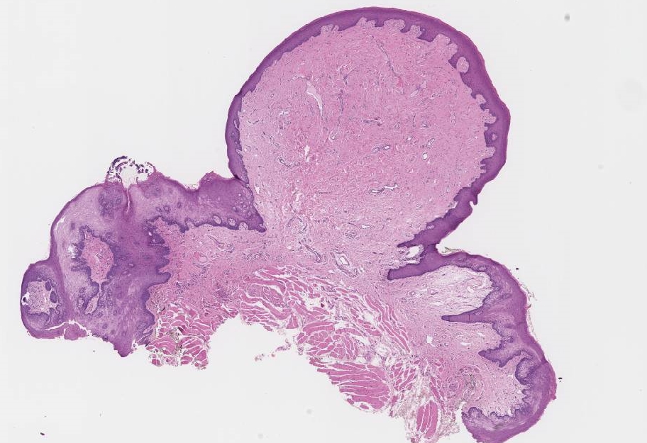 fibroma cavidad oral