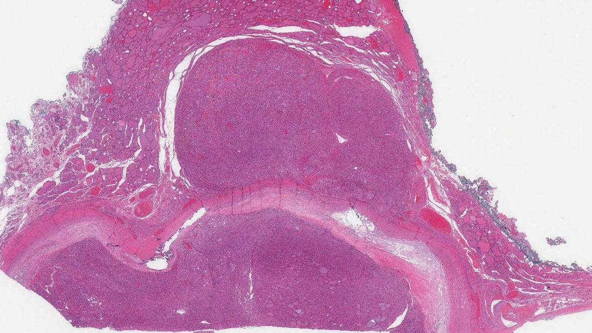 minimally invasive Hurthle cell carcinoma