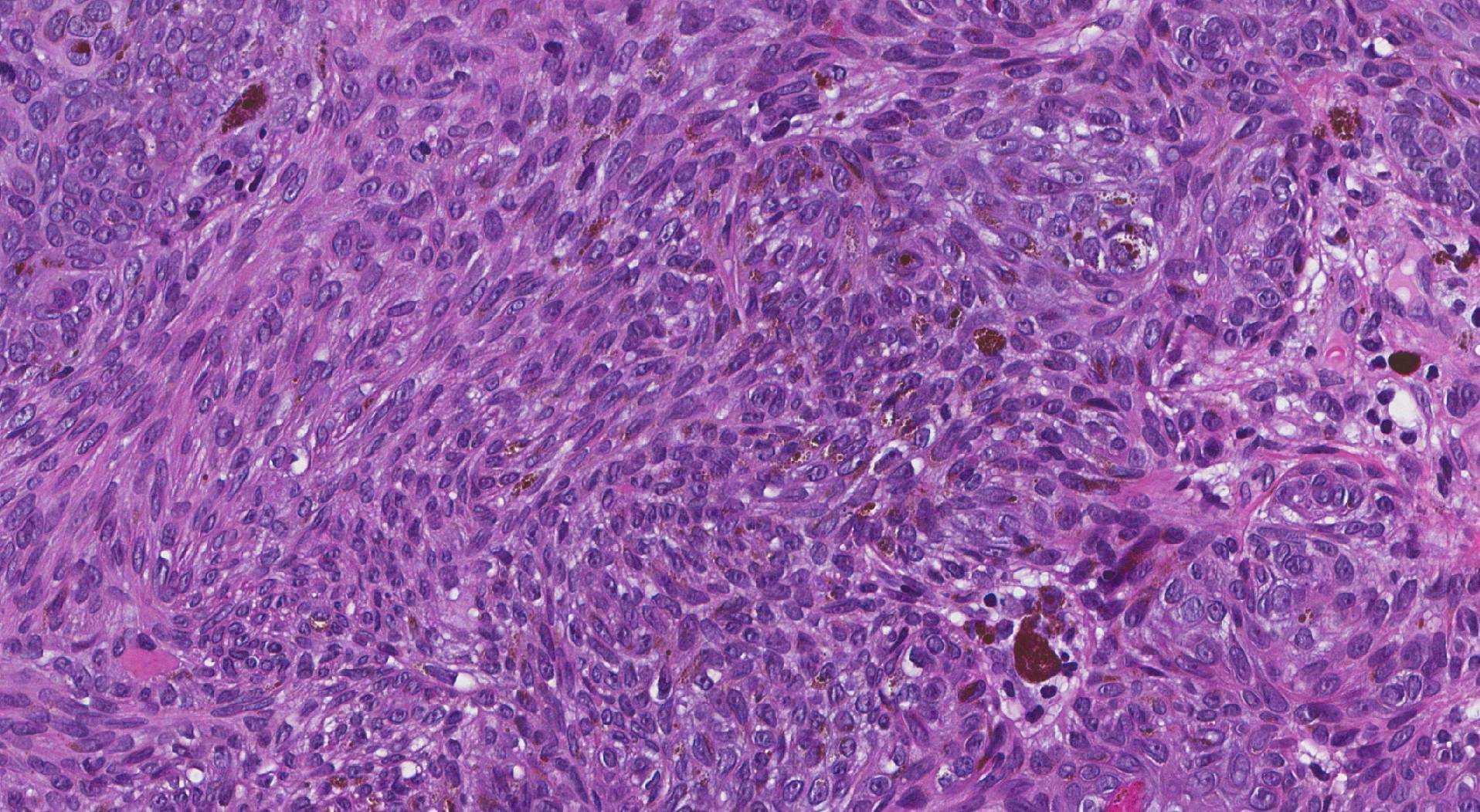 Pigmented basal cell carcinoma
