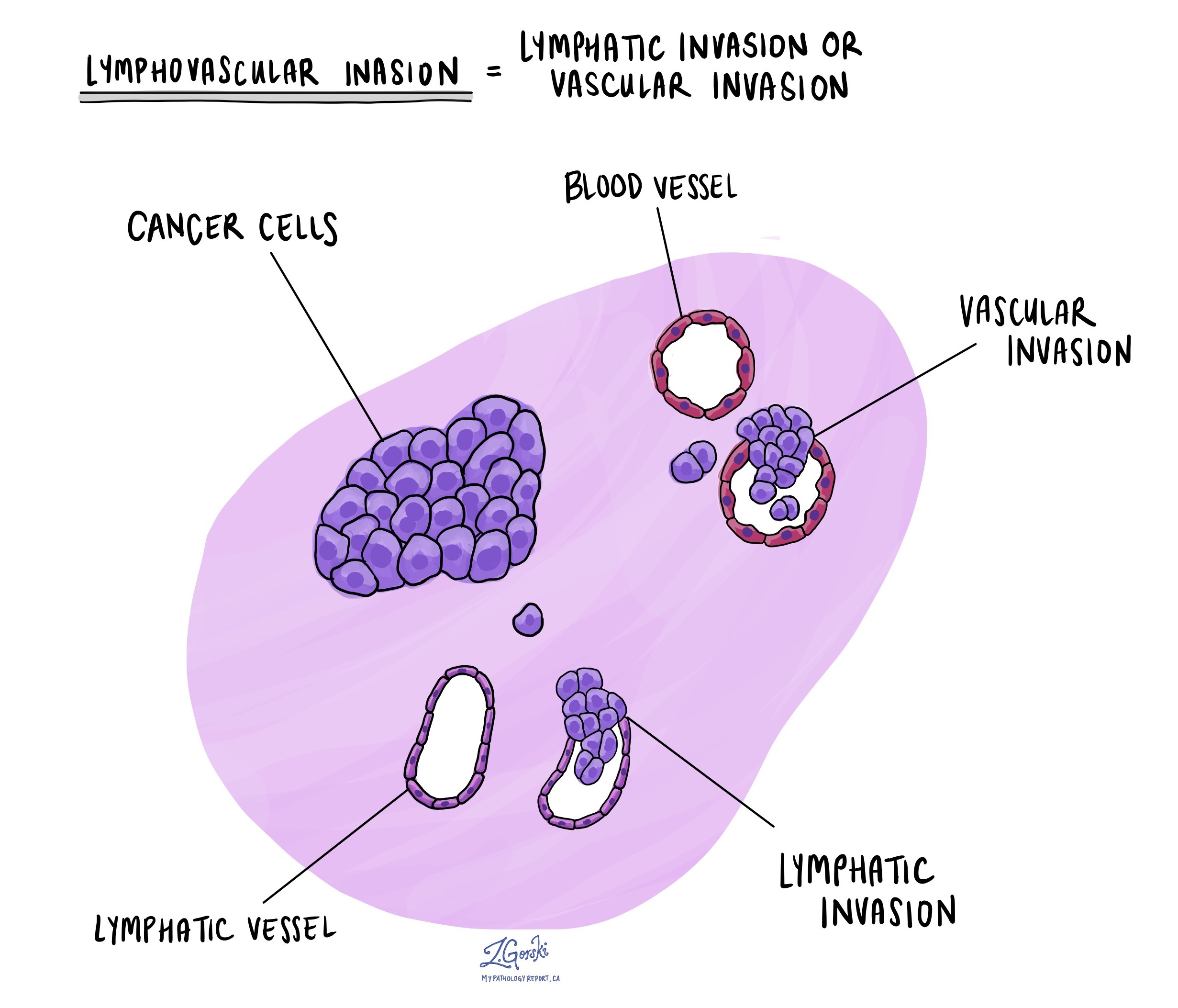 Invasión linfovascular