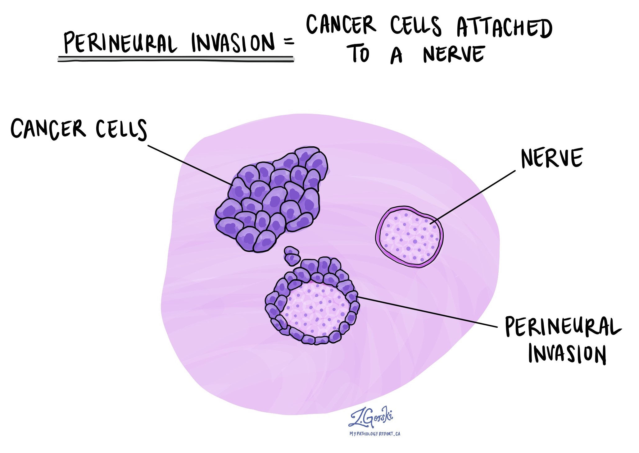 Invasión perineural