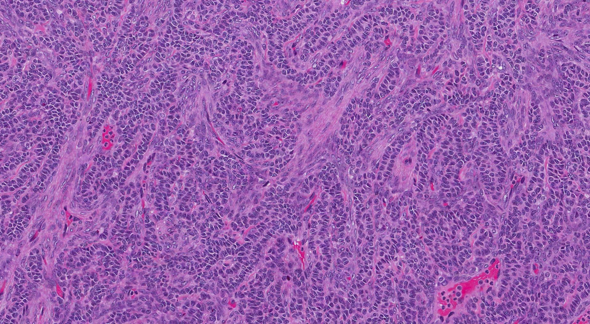 Adult type granulosa cell tumour