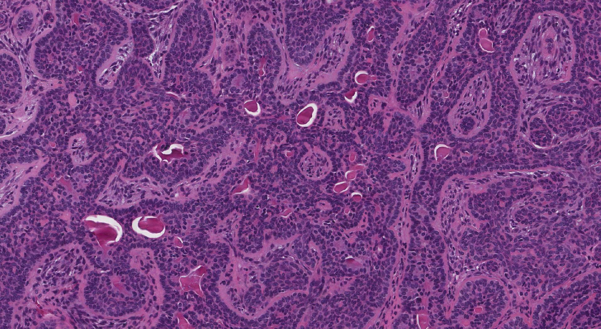 Basal cell adenoma