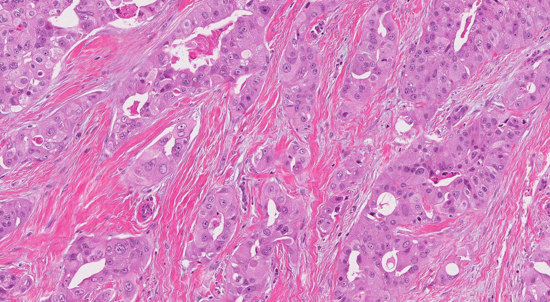 Invasive ductal carcinoma with apocrine features