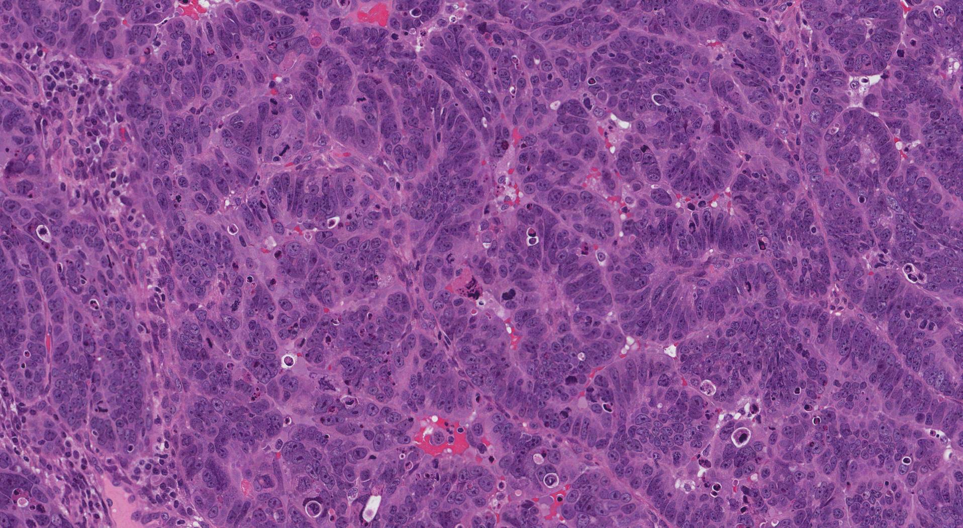 Cancers Free Fulltext Endometrial Serous Carcinoma