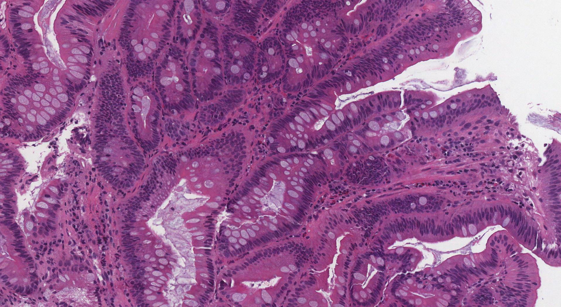 adenoma duodenal