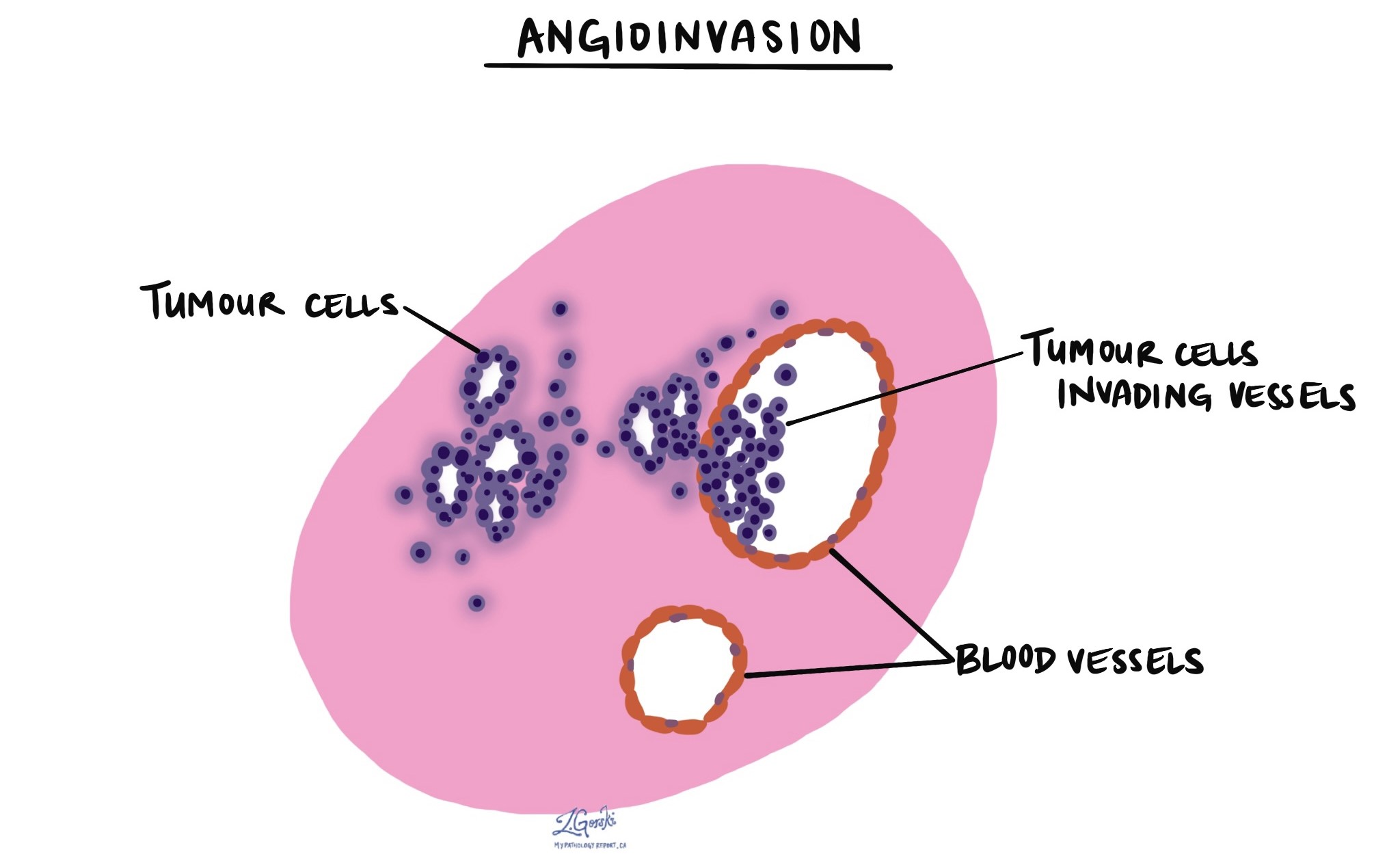 Angioinvasion MyPathologyReport ca