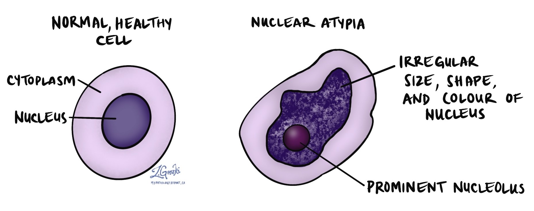 nuclear atypia
