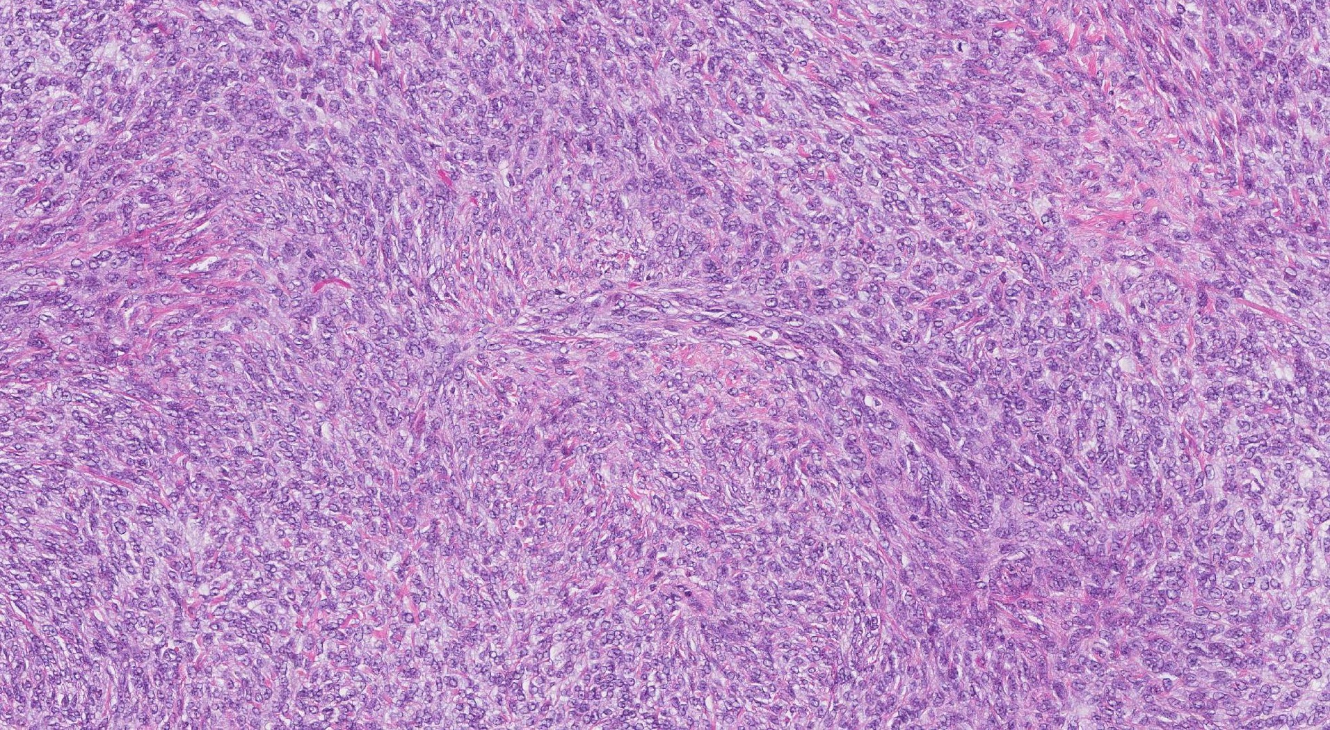 ovario fibroma celular