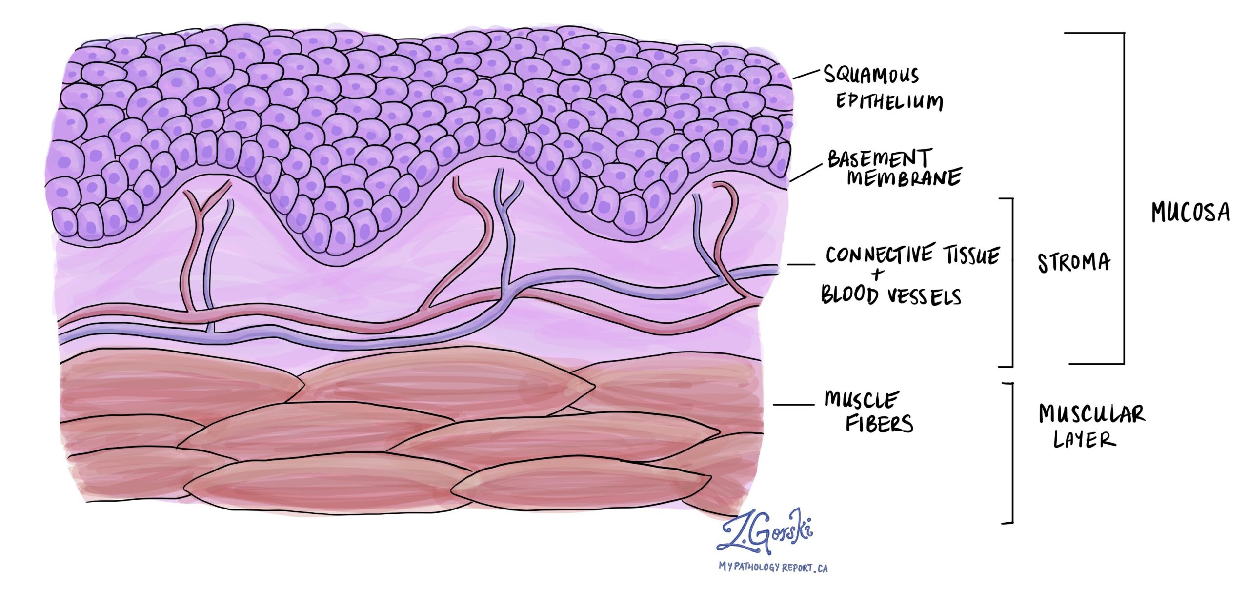 Squamous epithelium MyPathologyReport.ca