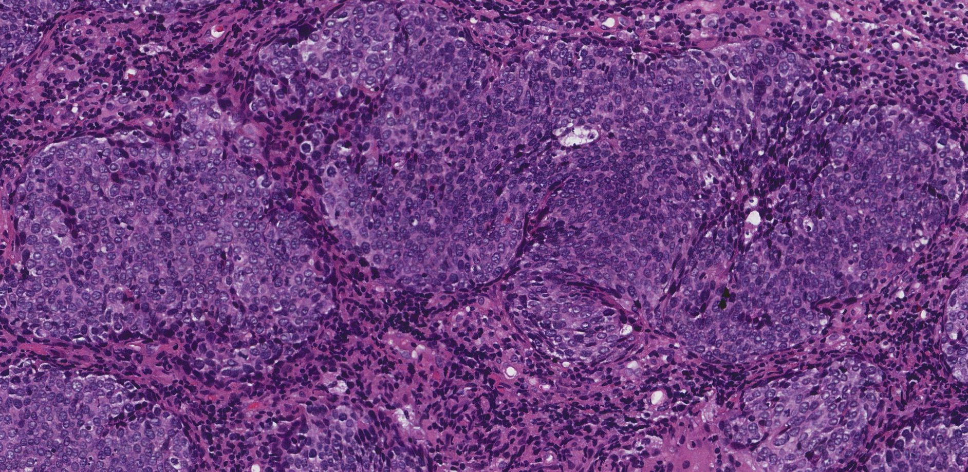 This picture shows an example of nonkeratinizing squamous cell carcinoma of the oropharynx.
