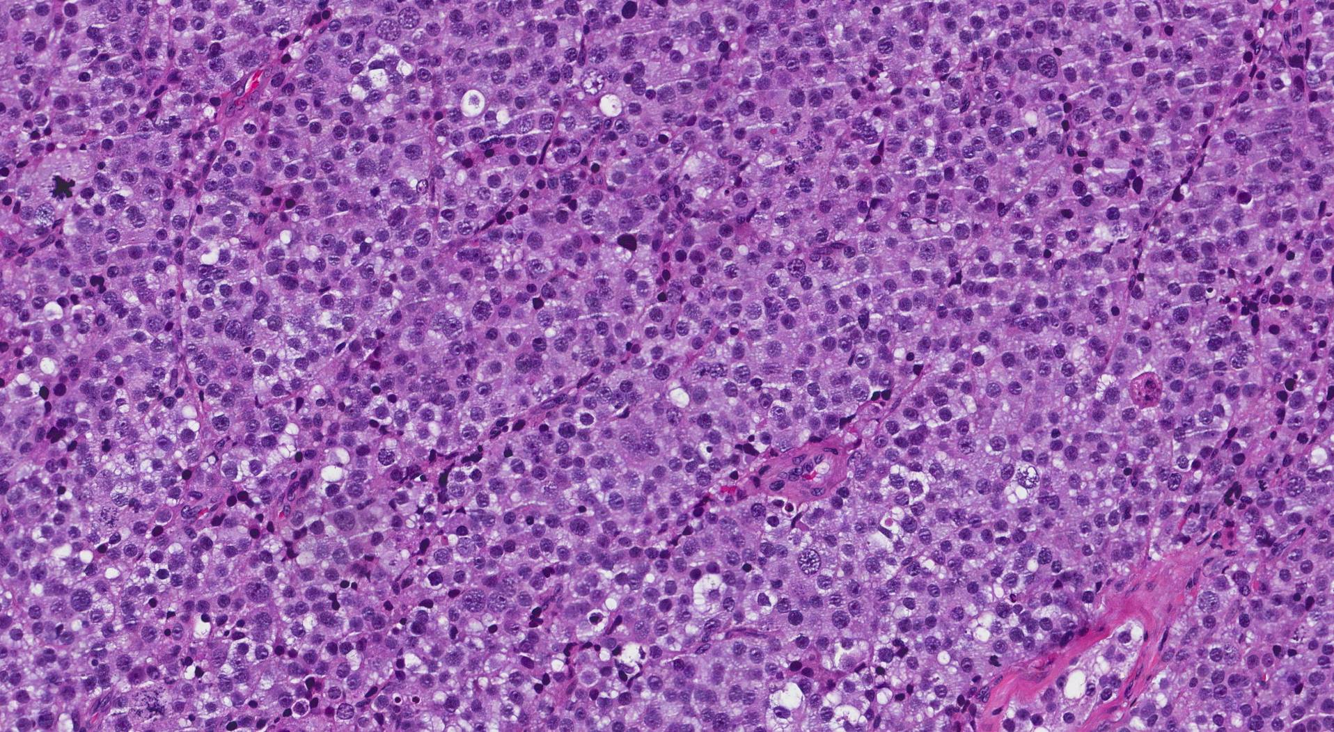 spermatocytic tumour