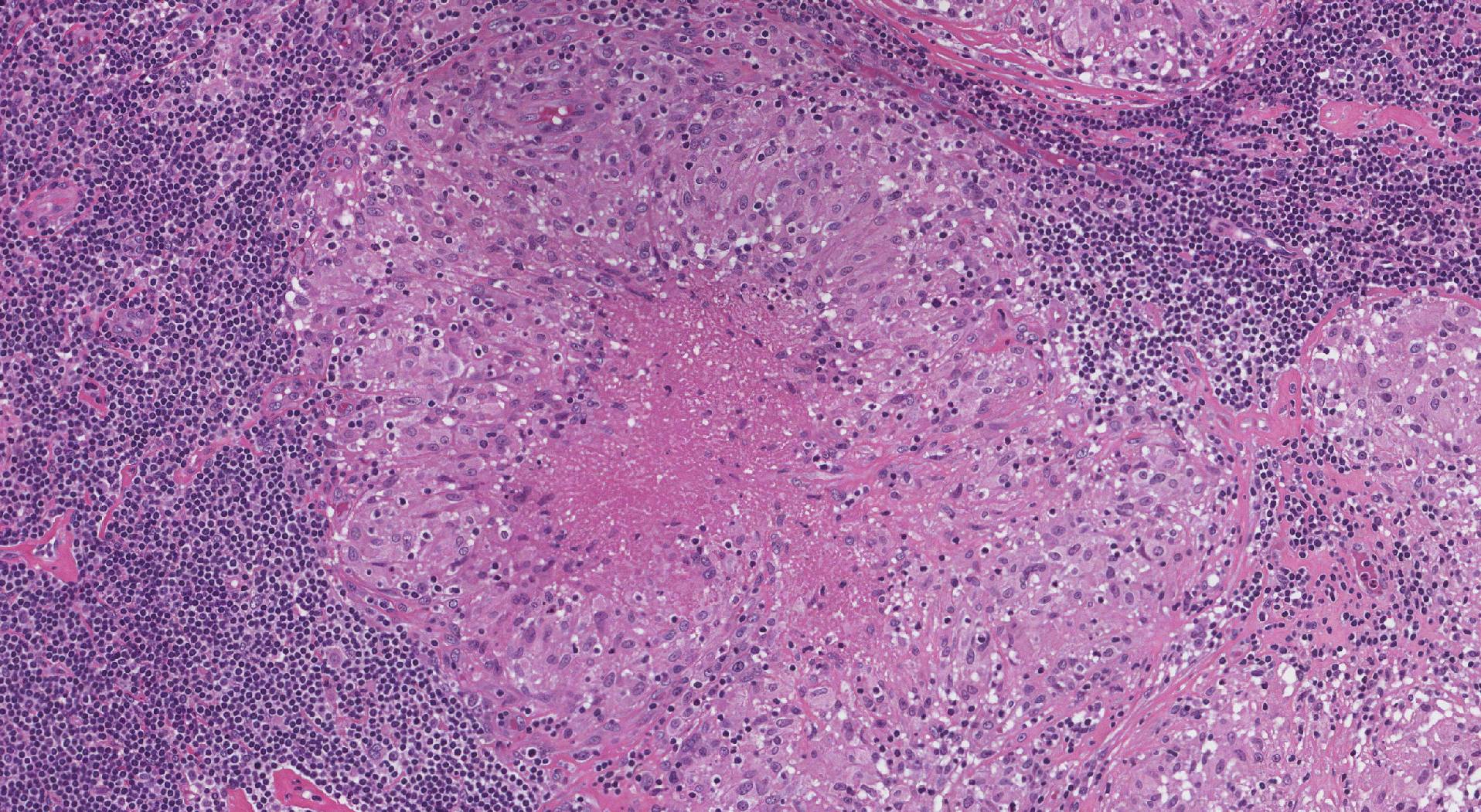 epithelioid cells in a granuloma