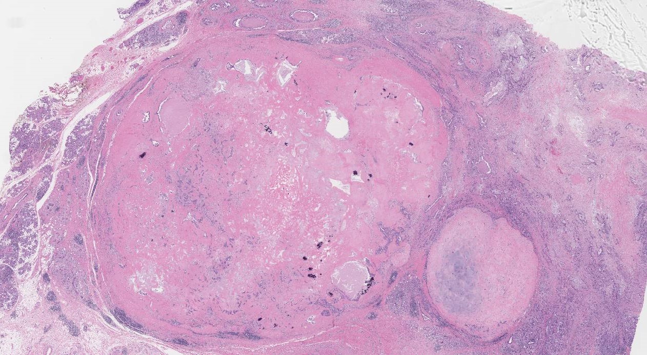 元多形腺腫癌の原因は何ですか?誰がリスクにさらされていますか?