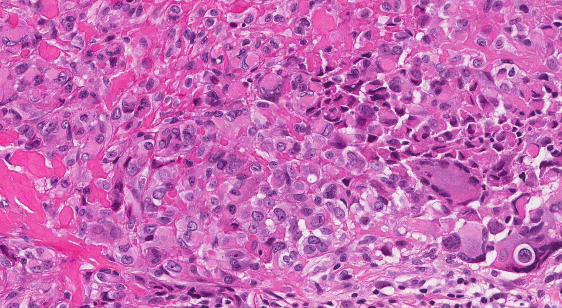 Sarkom Epitheloiden Histologie Epitheloides Angiosarkom IUKREE