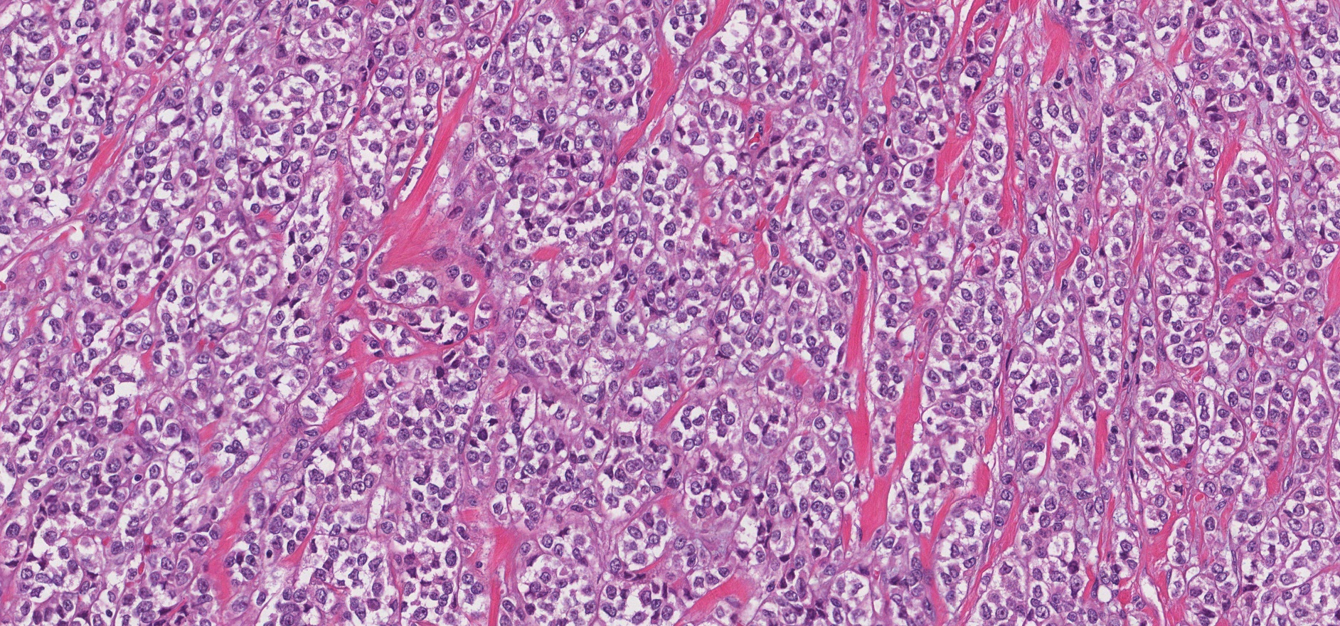 Myoepithelial carcinoma of the salivary glands