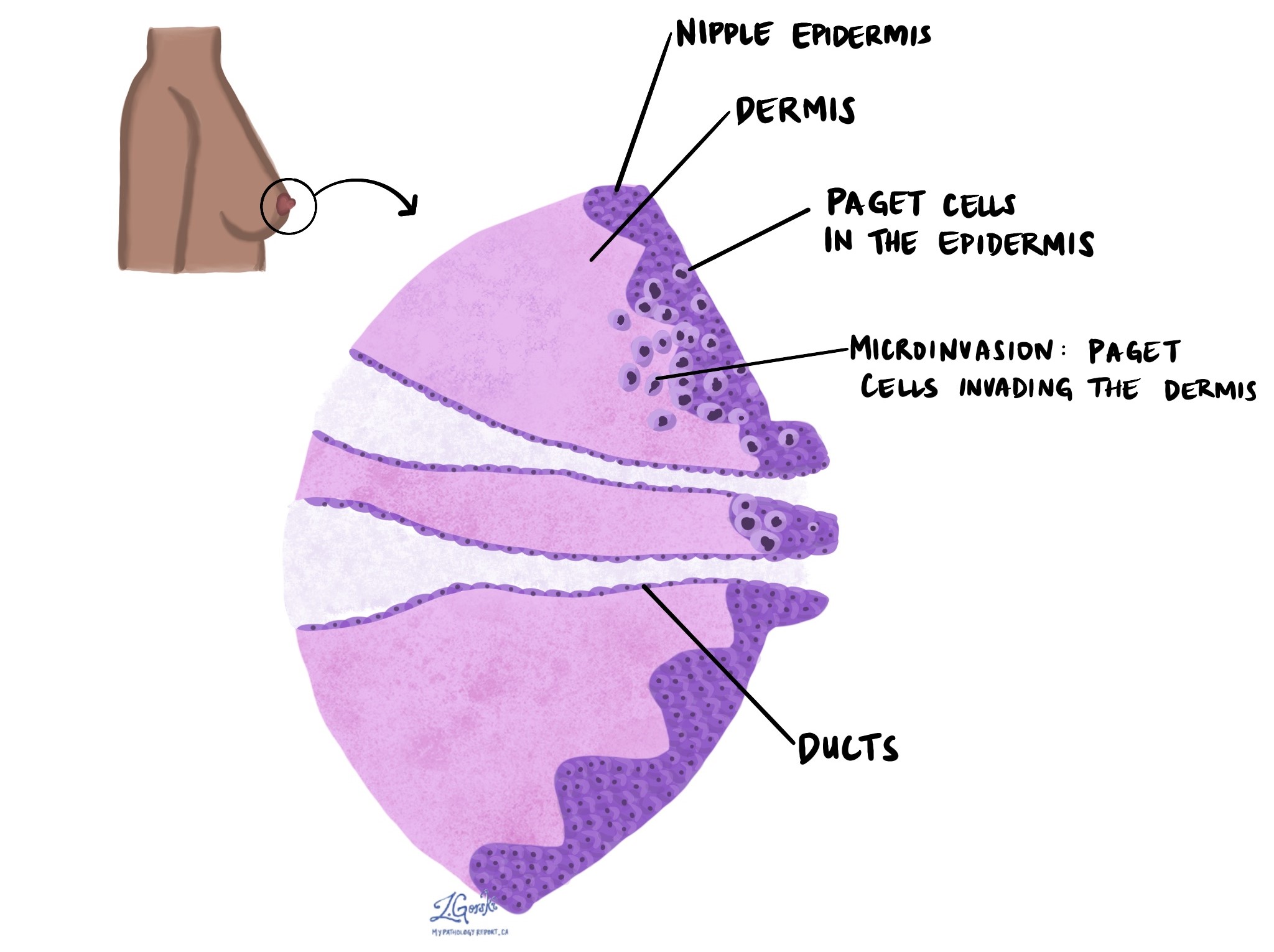 Paget disease of the breast with microinvasion