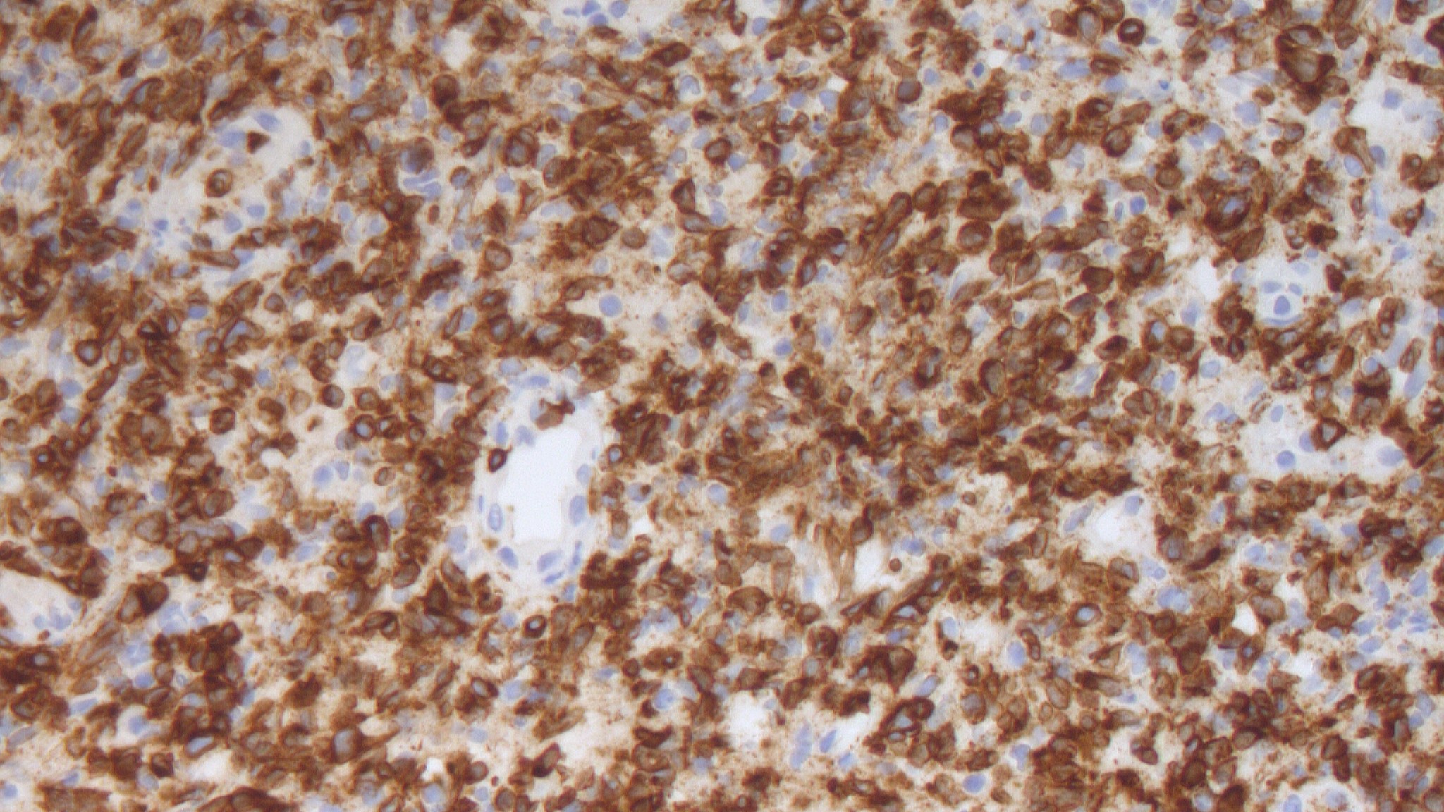 Expression of CD3 in extranodal NK T cell lymphoma