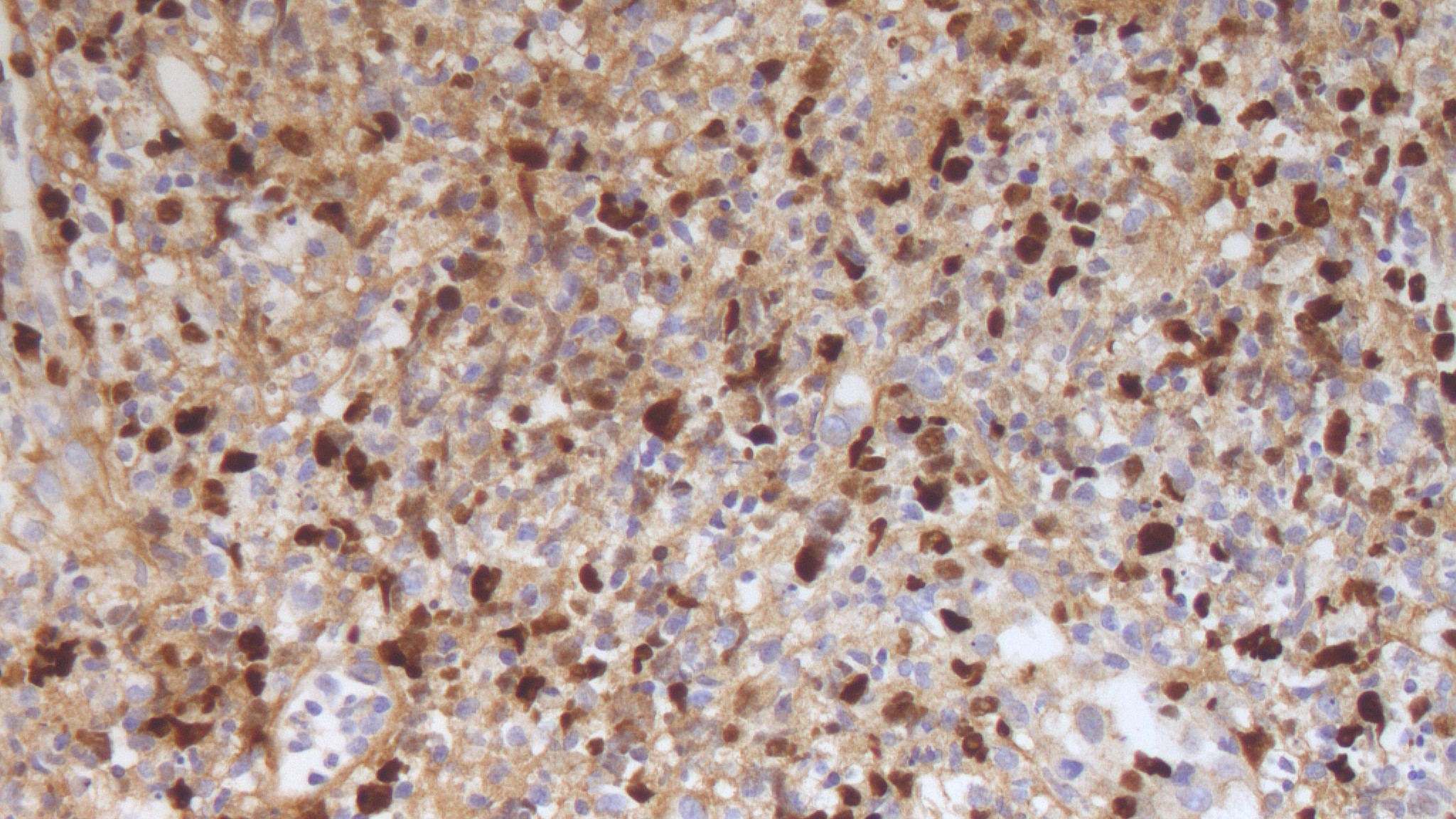 Expression of EBER in extranodal NK/T cell lymphoma