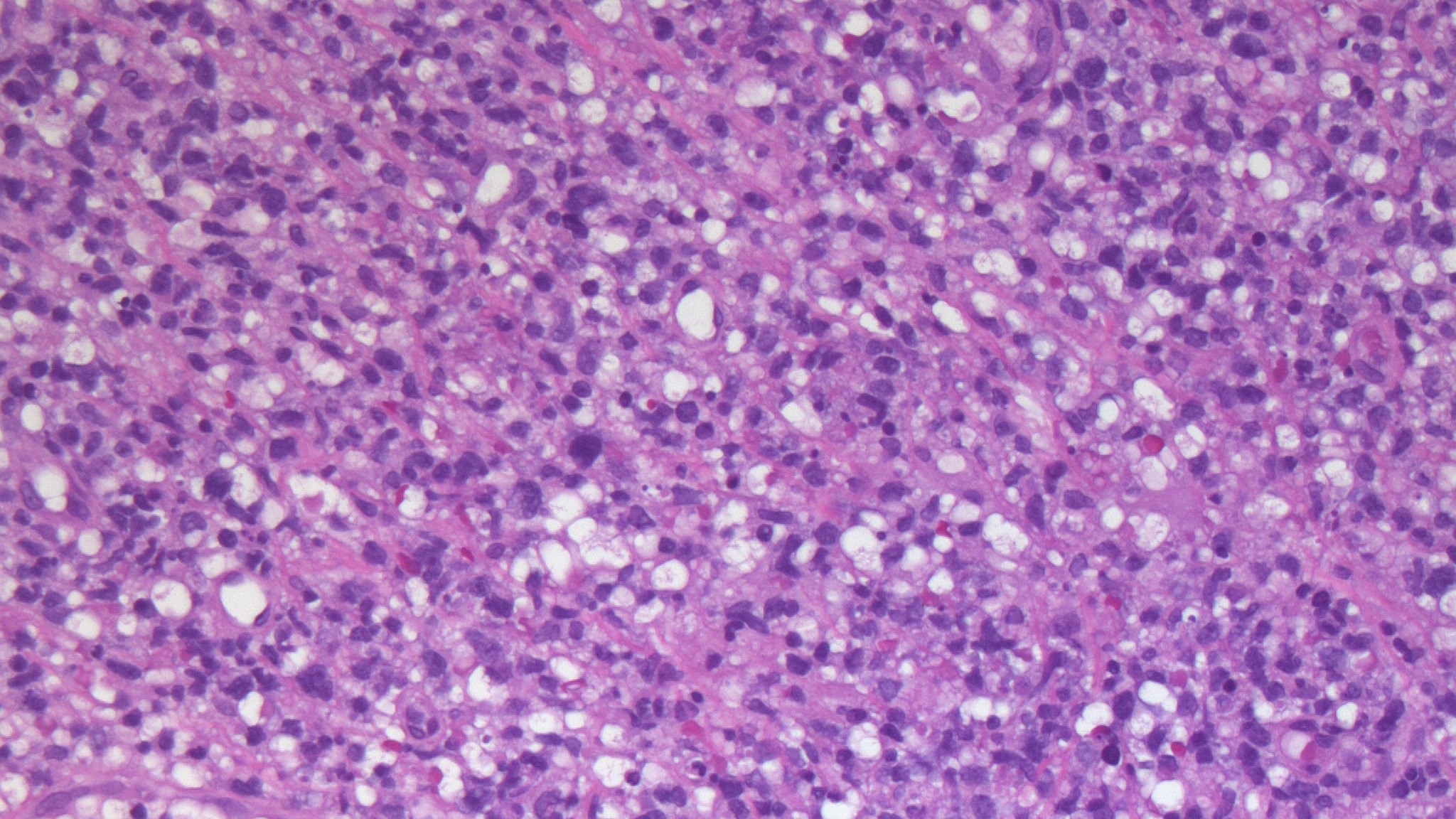 Extranodal NK/T cell lymphoma