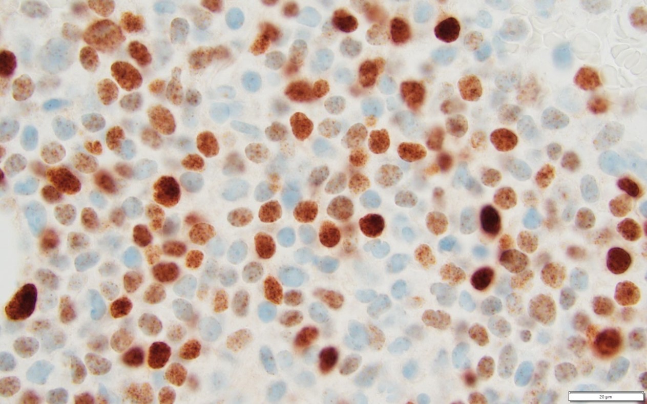 TdT-immunfärgning av T-lymfoblastisk leukemi