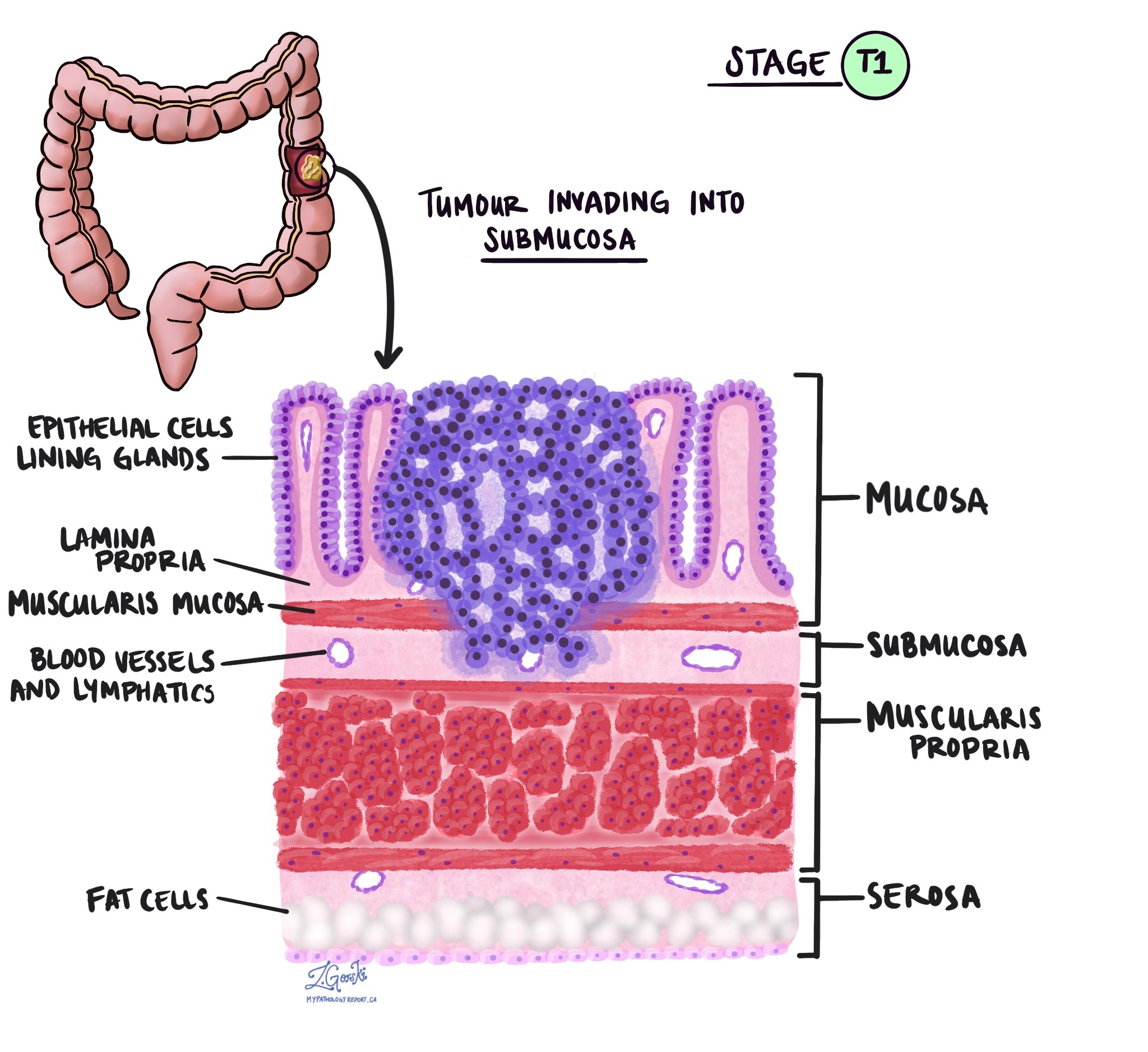 Adenocarcinoma of the colon pathologic tumour stage T1
