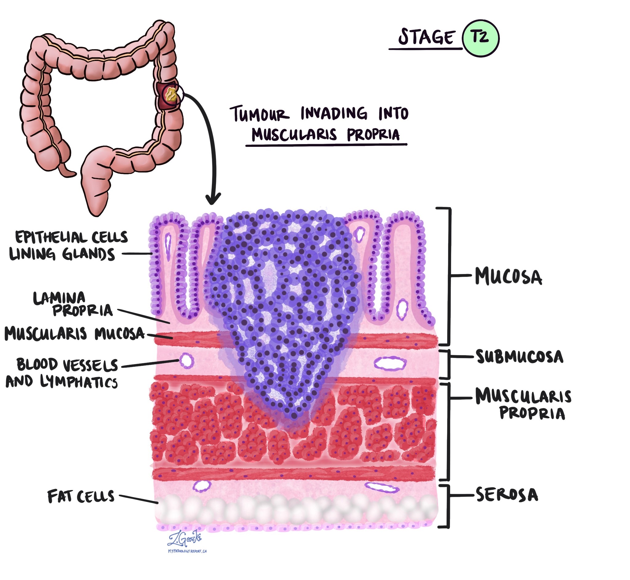 Adenocarcinoma of the colon pathologic tumour stage T2
