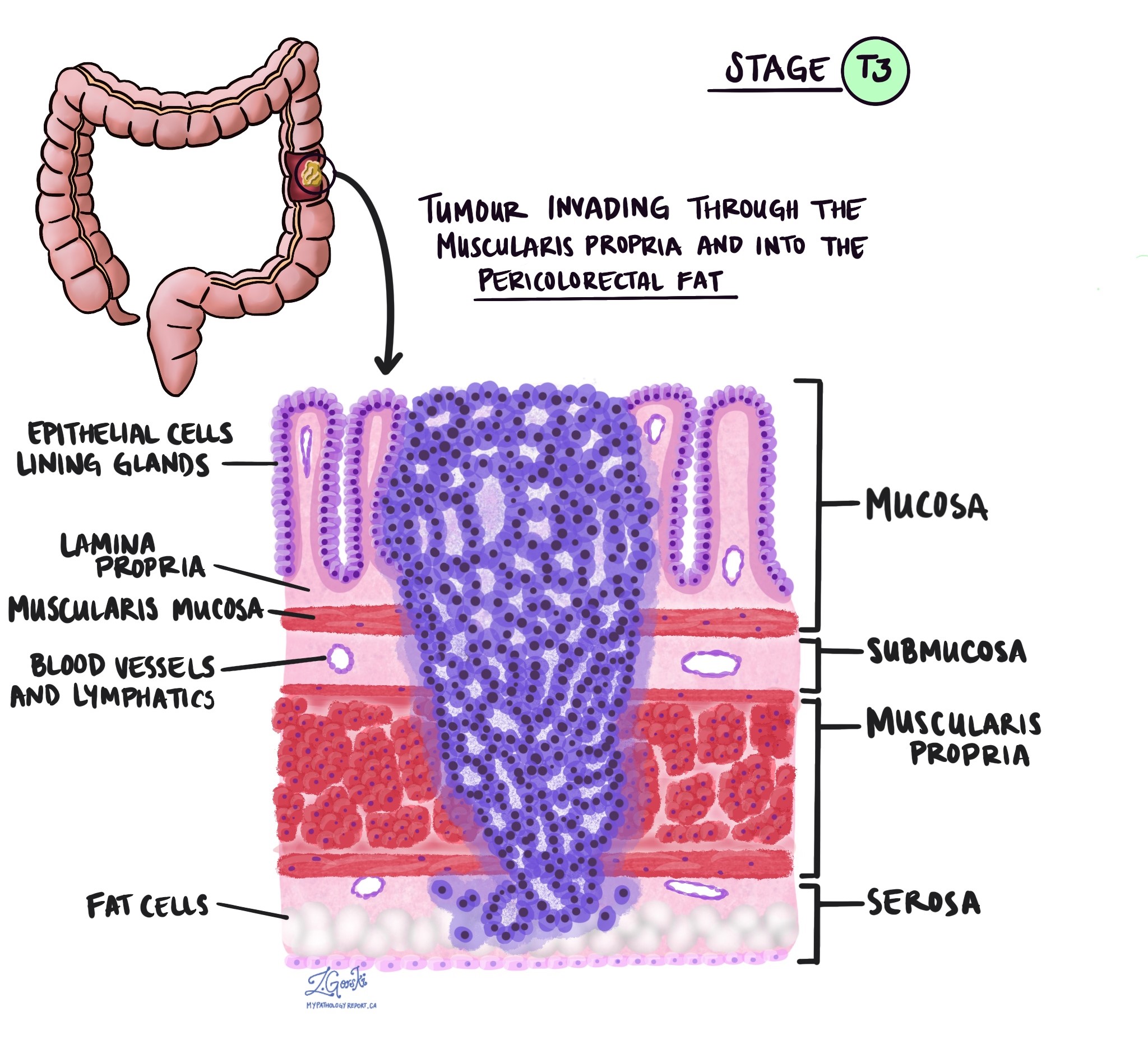 Adenocarcinoma of the colon pathologic tumour stage T3