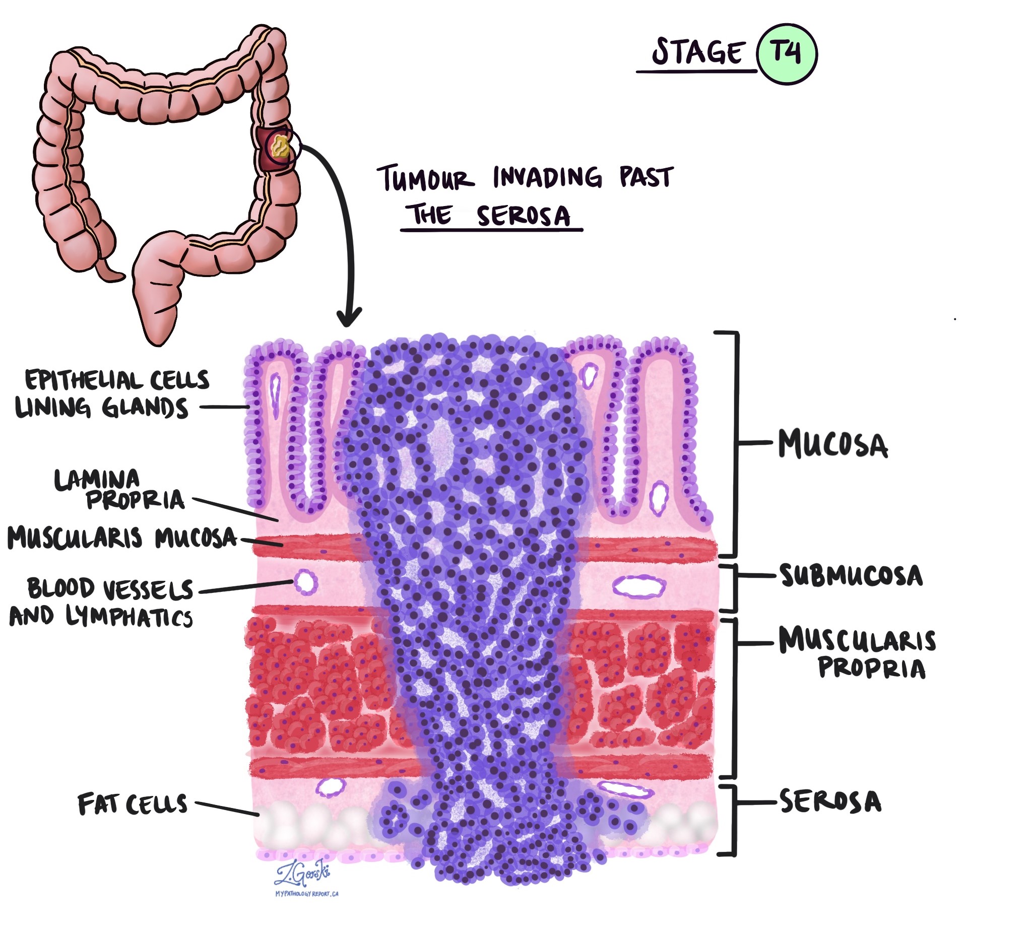 Adenocarcinoma of the colon pathologic tumour stage T4