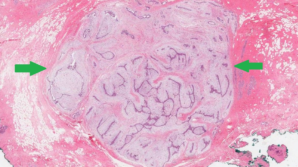 This picture shows a benign tumour in the breast (between green arrows).