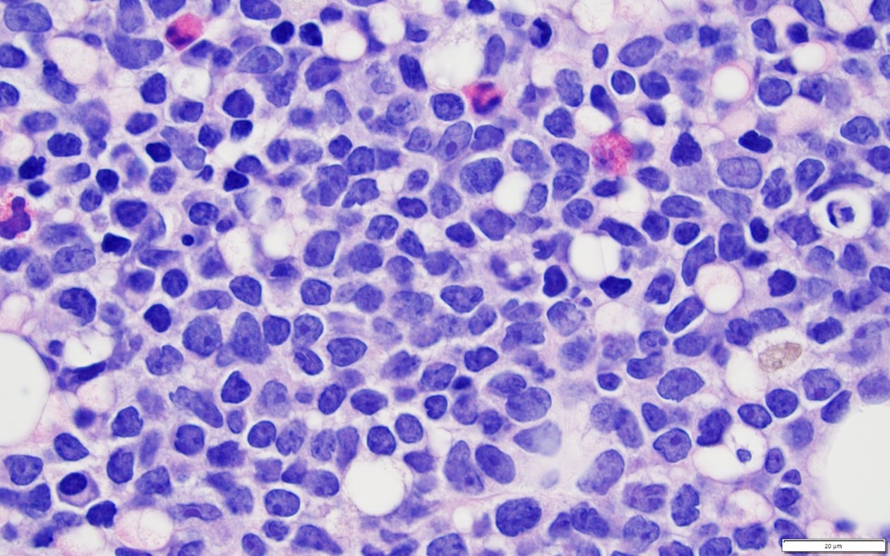 benmärgsbiopsi T-lymfoblastisk leukemi