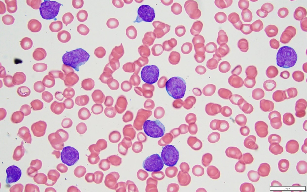 perifert blodutstryk T-lymfoblastisk leukemi
