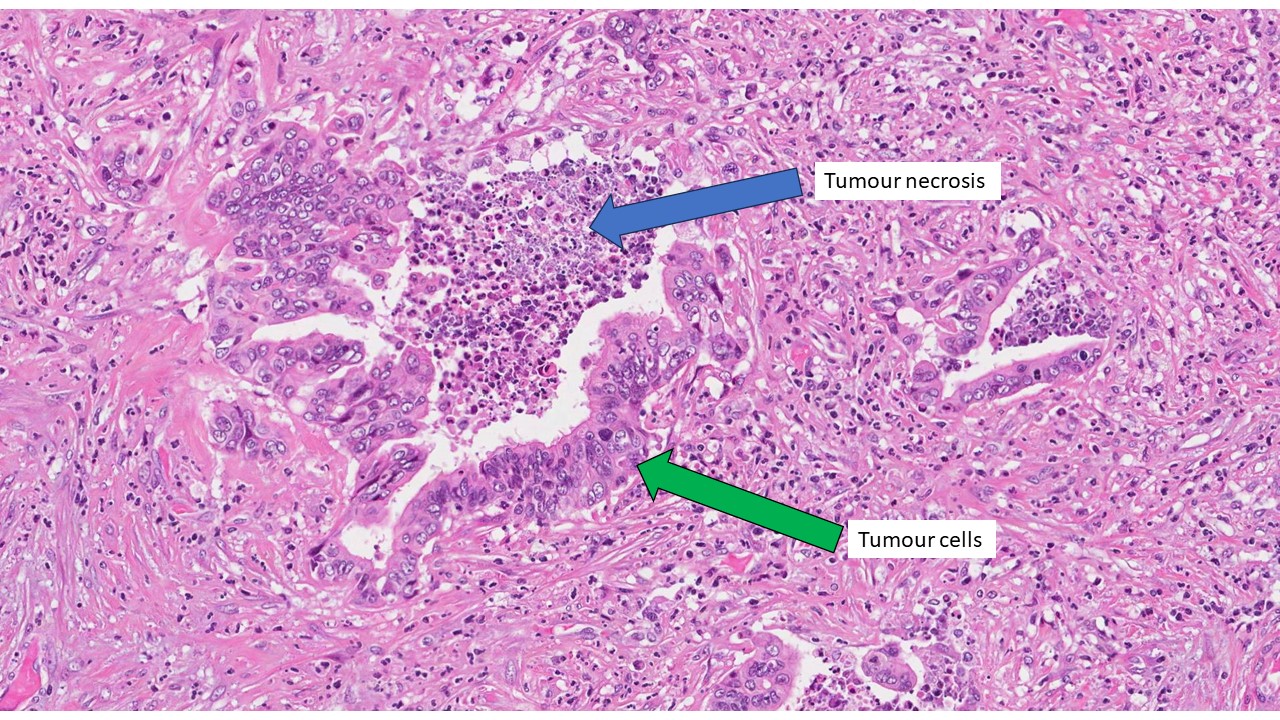 nekrosis ng tumor