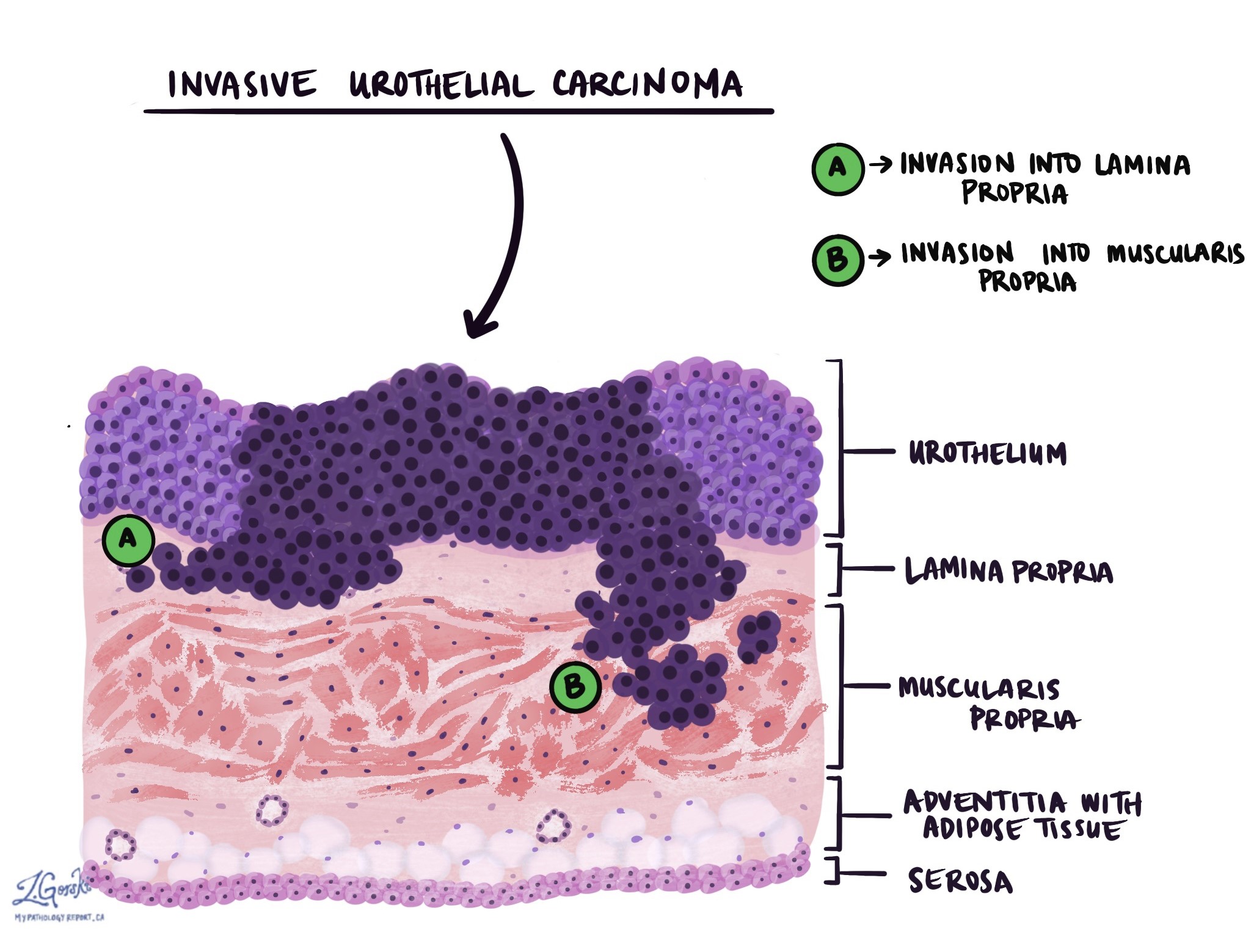 Invasivt urotelialt karcinom