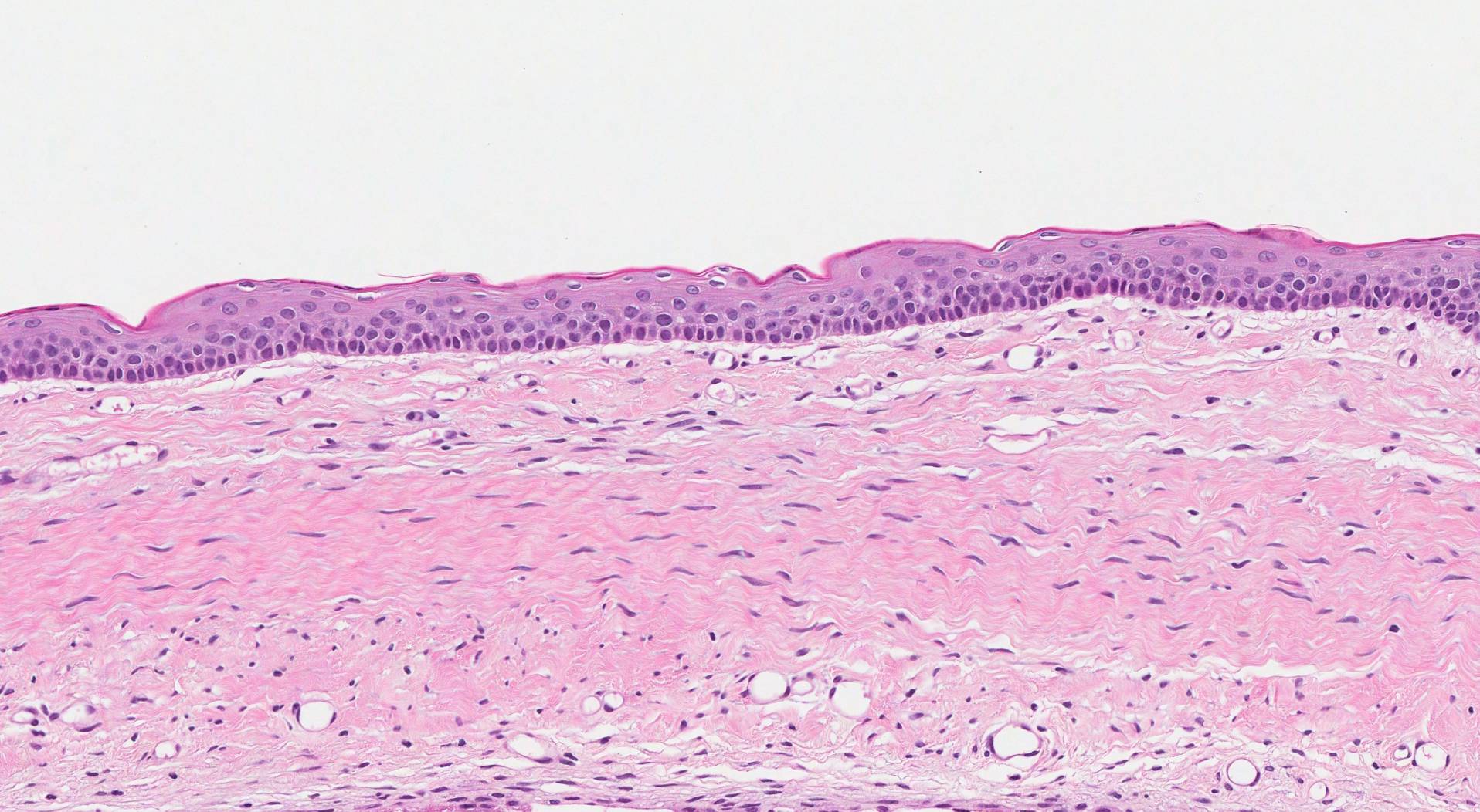 Odontogenic keratocyst