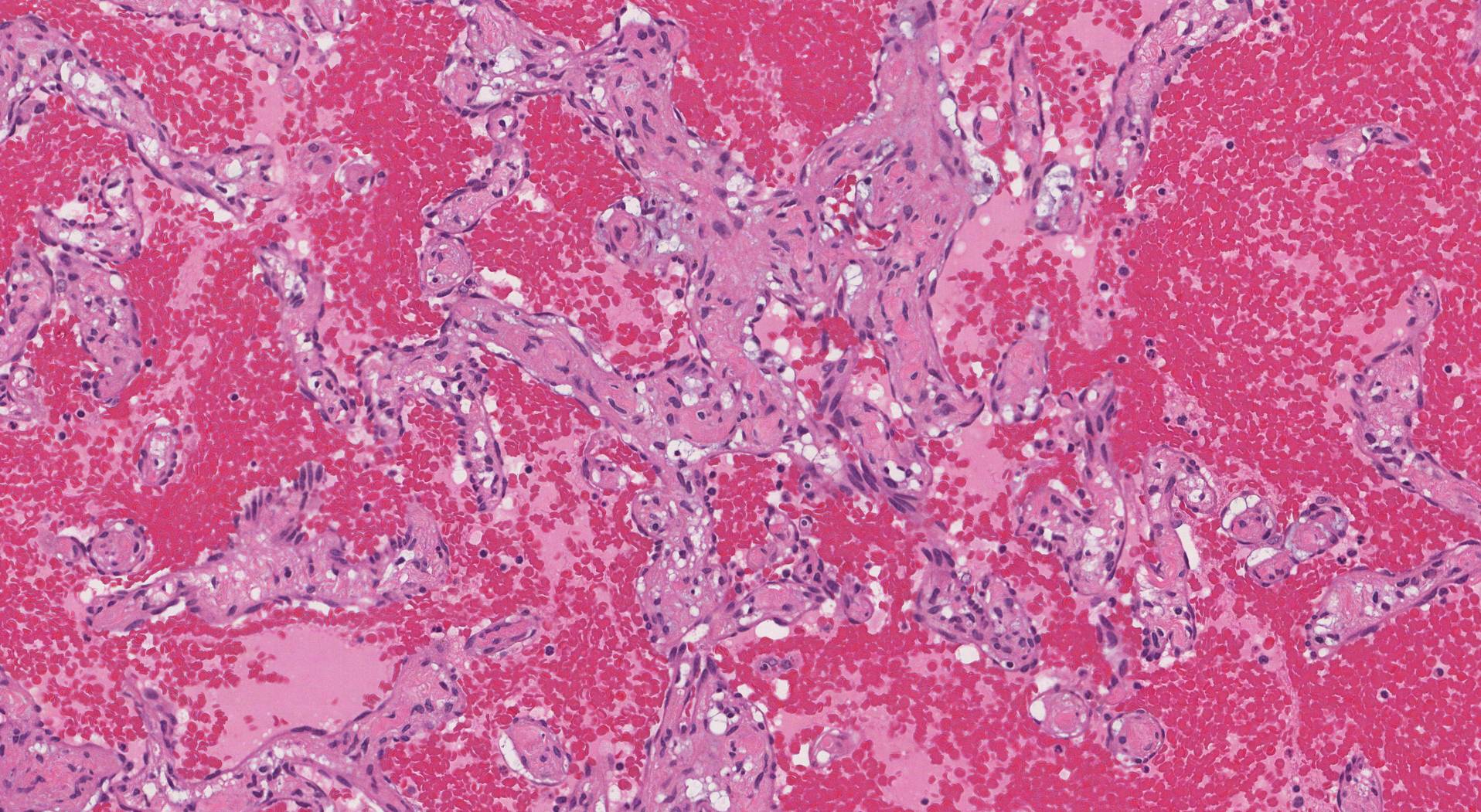 这张照片显示了肝脏中一种称为血管瘤的血管病变。