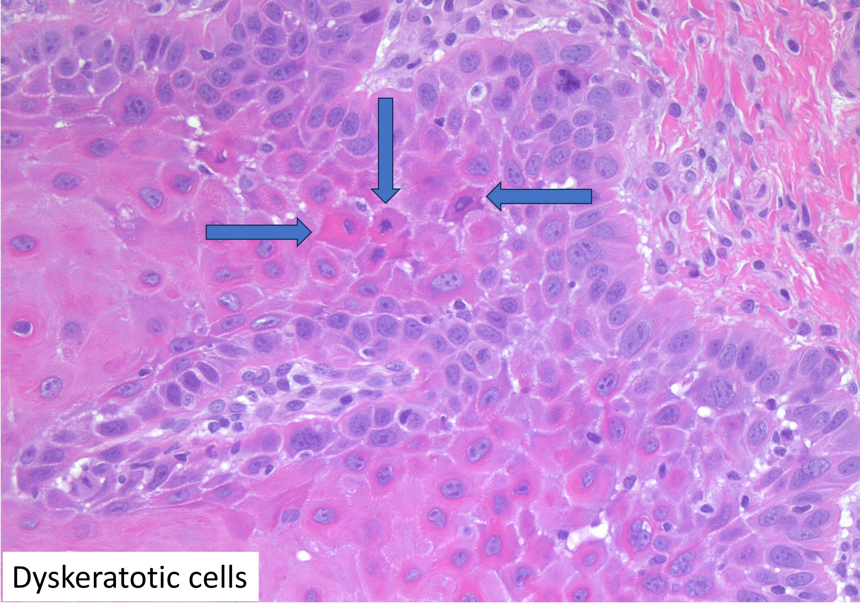 Dyskeratotic cells