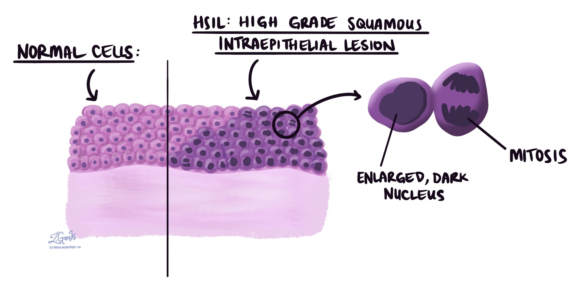 High grade squamous intraepithelial lesion
