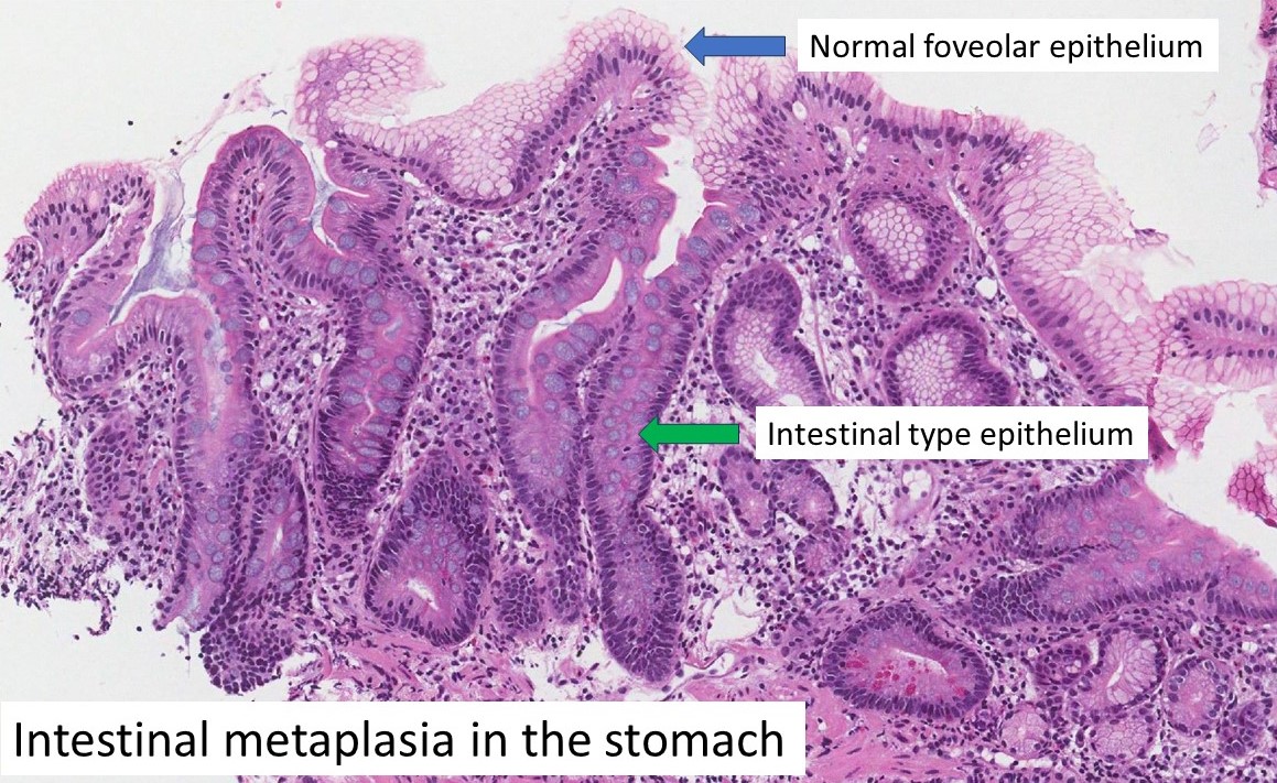 Intestinal metaplasia