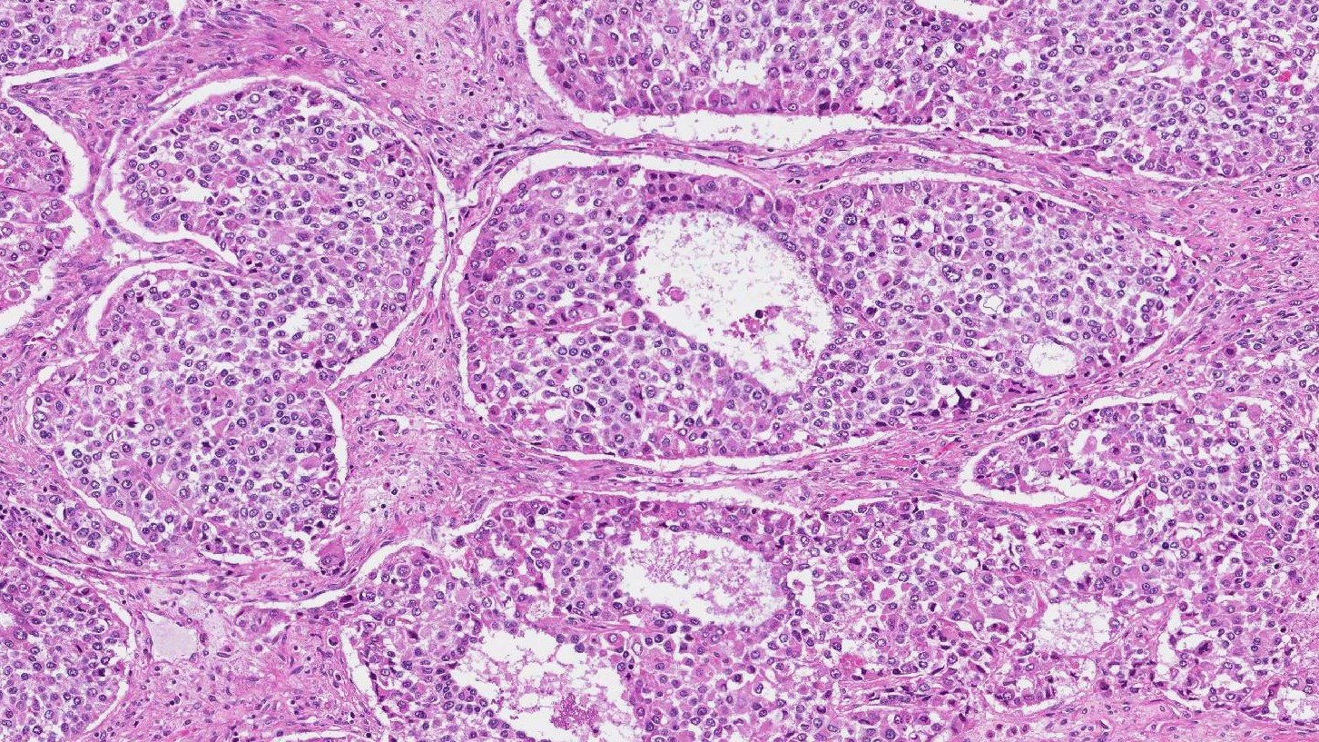 juvenile type granulosa cell tumour
