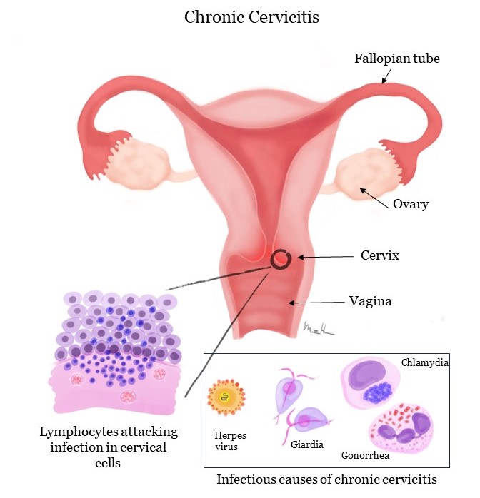Cervicite chronique | MonRapportPathologie.ca