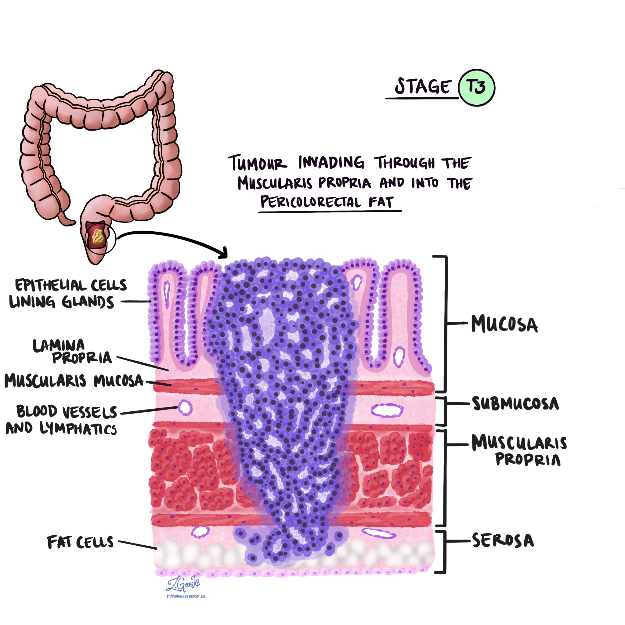 rectal adenocarcinoma T3