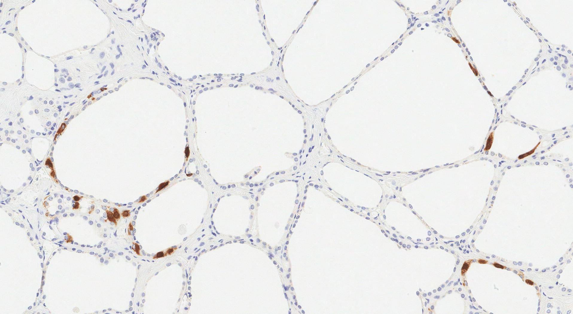 На цьому зображенні показано імуногістохімічне дослідження кальцитоніну в щитовидній залозі. С-клітини коричневі.