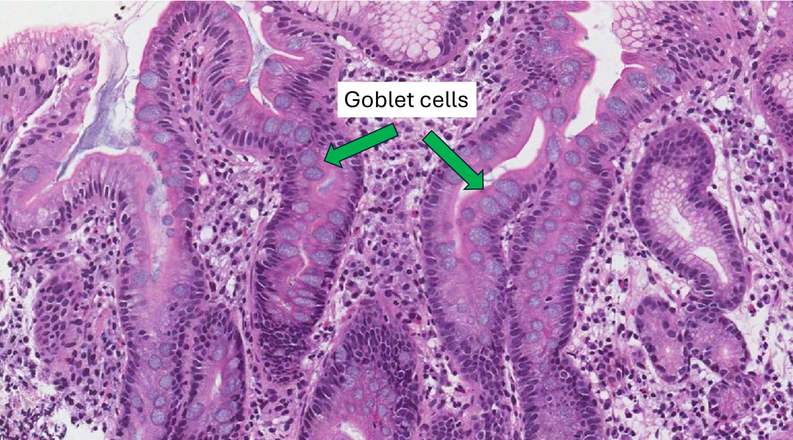 Бокаловидные клетки | MyPathologyReport.ca